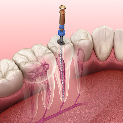 Endodonzia Conservativa